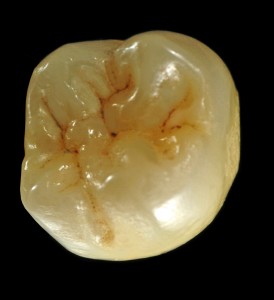 CORONA ANATOMICA IN OSSIDO DI ZIRCONIO TRASLUCENTE